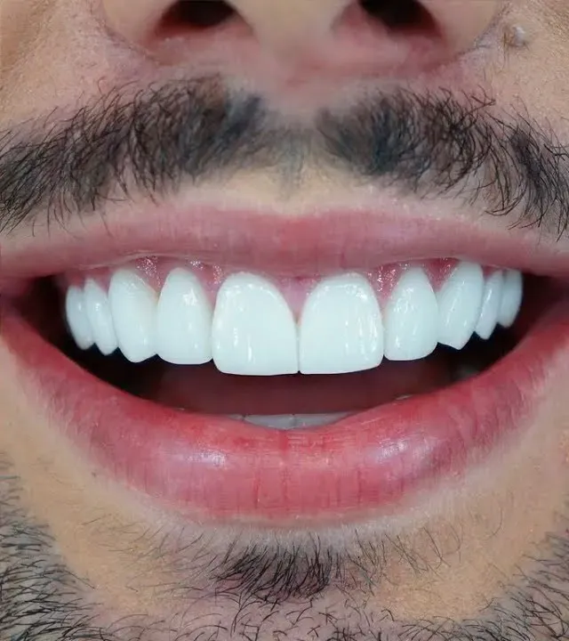 Antes