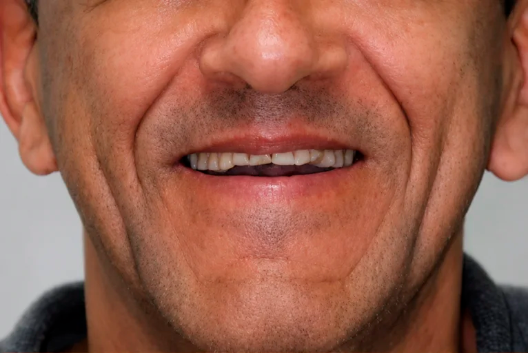 Antes do tratamento com facetas de porcelana