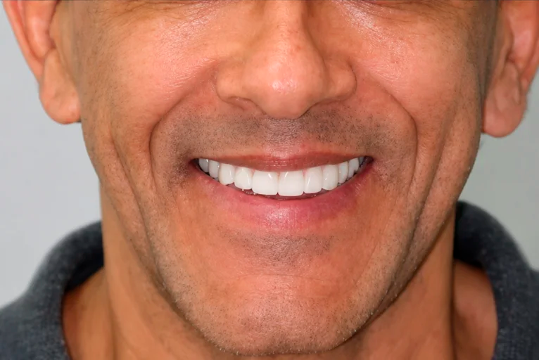 Depois do tratamento com facetas de porcelana