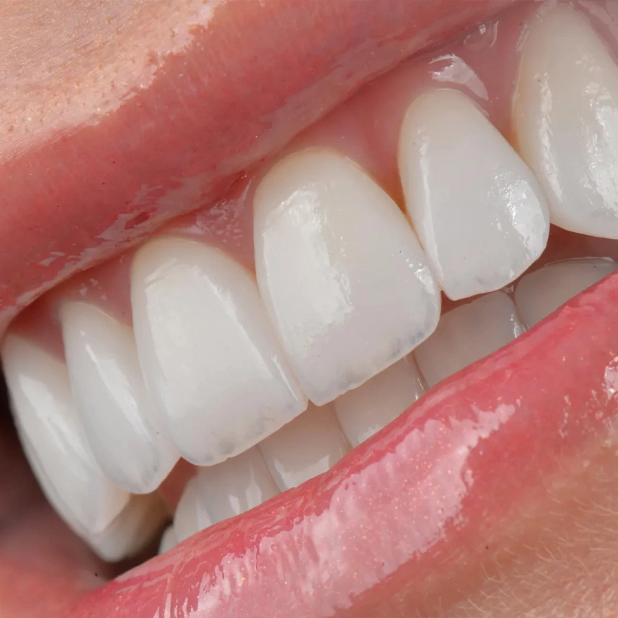 Resultado facetas de porcelana